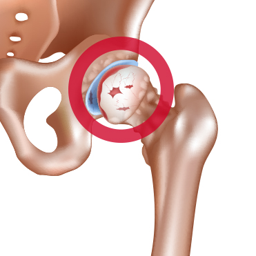 Dr. Matthias Marquardt - Verletzung - Arthrose