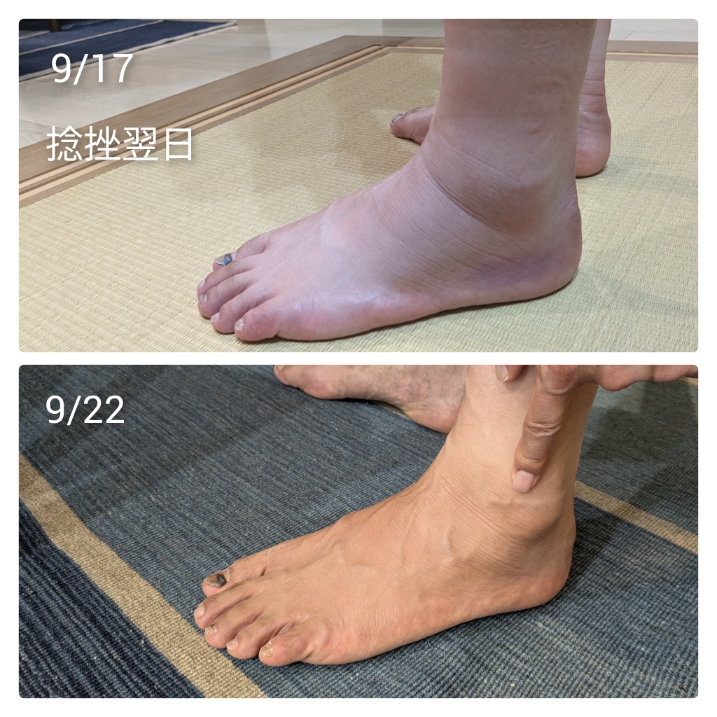 捻挫の痛みの緩和&浮腫み解消