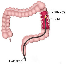 Darmspiegelung Ablauf - Wie wird eine Koloskopie durchgeführt. Dr. Kisser Wien 