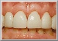 Ceramic Veneers