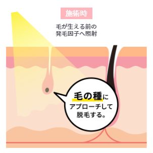 痛くない脱毛サロンDione吉祥寺本店 ハイパースキン脱毛の仕組み1