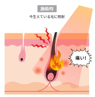 痛くない脱毛サロンDione吉祥寺本店 エステ脱毛・医療脱毛の仕組み1
