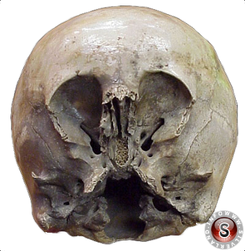 The Starchild skull - Il teschio Starchild