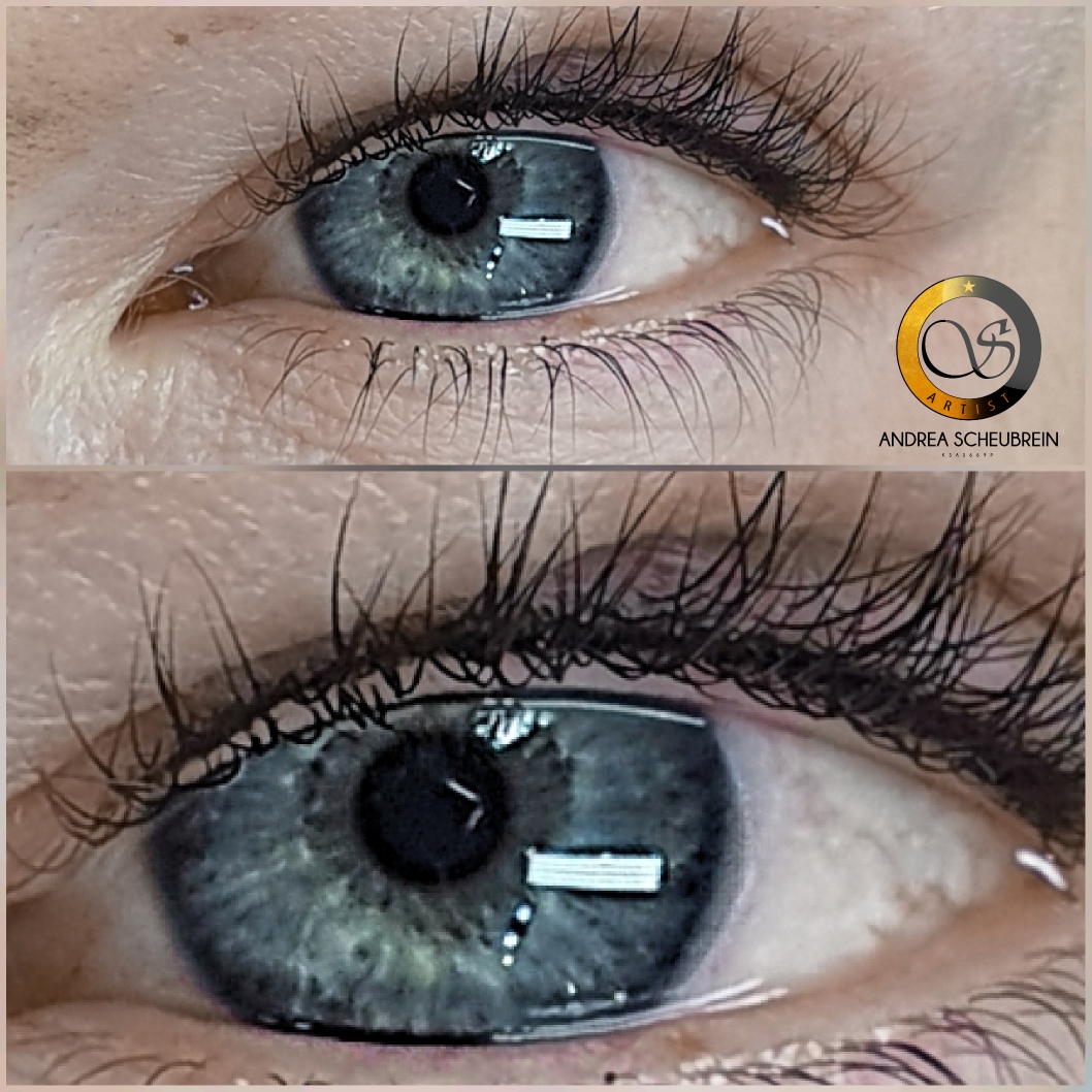 Wimpernkranzverdichtung 