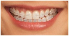 Traitements d'orthodontie discrets