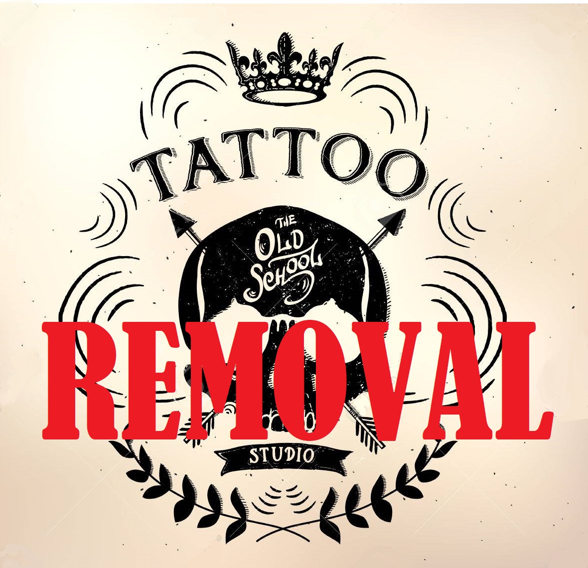 Eliminación de Tatuajes