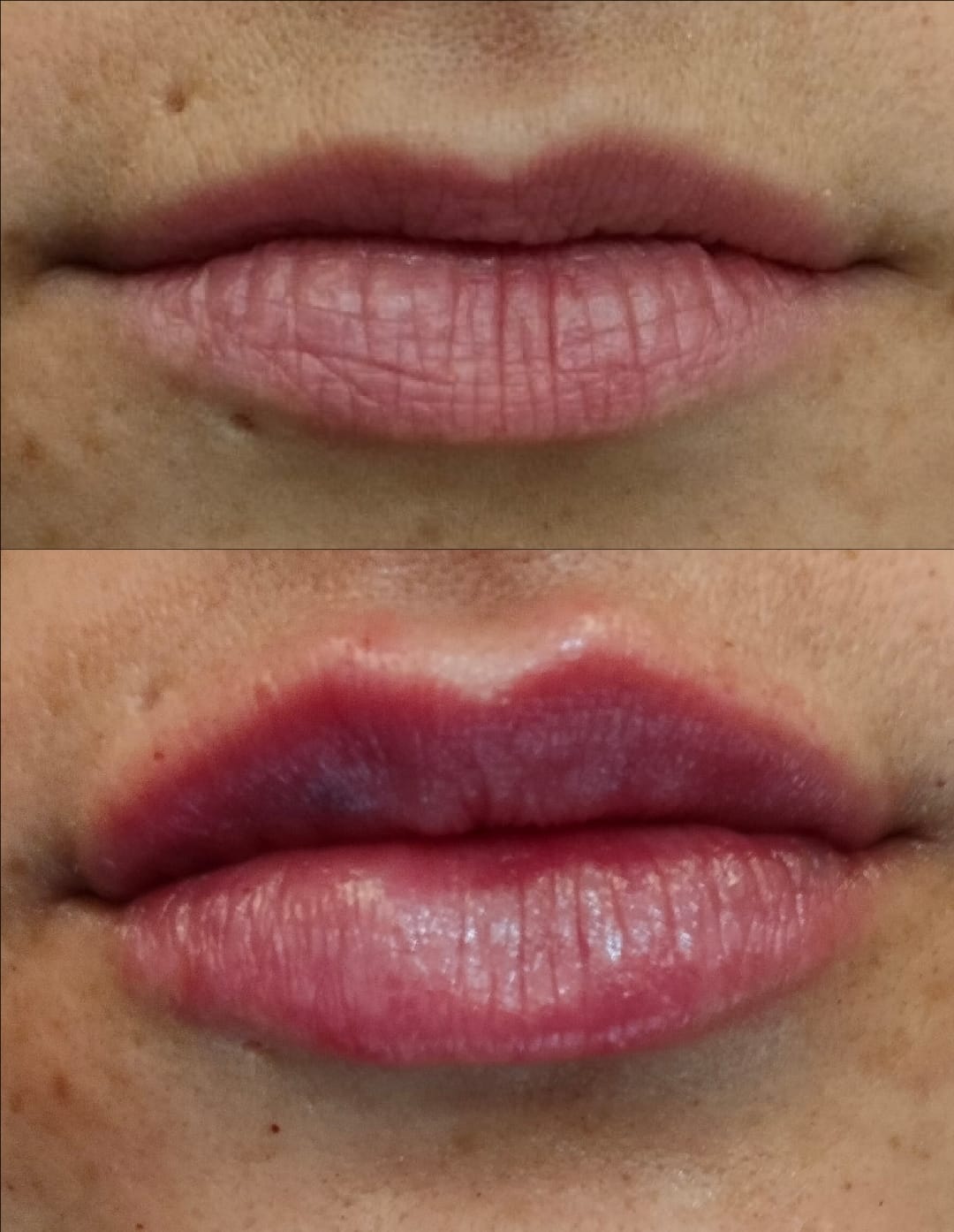 Aumento de labios