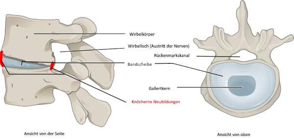 Wirbelsäule, Bandscheibe, Spondylose