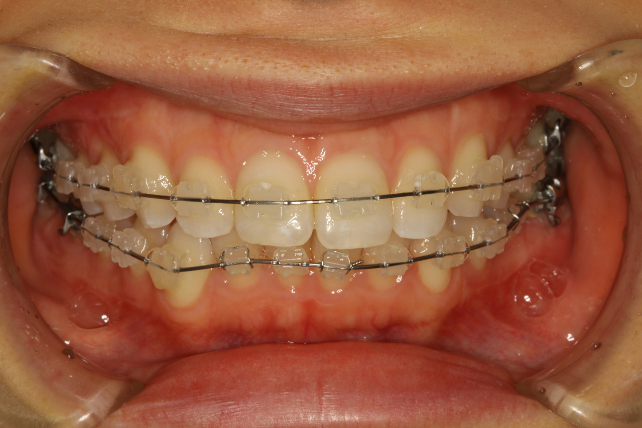 矯正モニターと料金 東京で通う歯の矯正