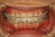 矯正中の虫歯治療