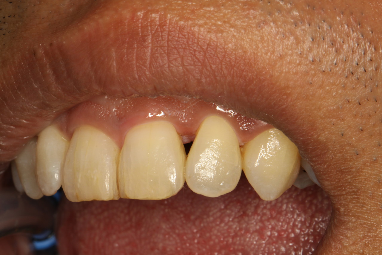 歯 と 歯茎 の 間 隙間