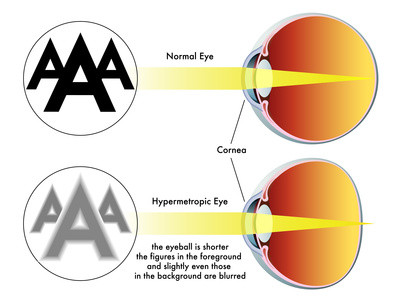 Hyperopia. Natural eyesight improvement. Alternative to glasses. Pinhole glasses. Bates Method Teacher. Bates Method exercises. How to improve my eyesight naturally.