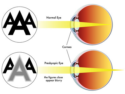 Presbyopia. Natural eyesight improvement. Alternative to glasses. Pinhole glasses. Bates Method Teacher. Bates Method exercises. How to improve my eyesight naturally.