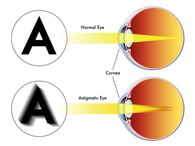 Astigmatism. Natural eyesight improvement. Alternative to glasses. Pinhole glasses. Bates Method Teacher. Bates Method exercises. How to improve my eyesight naturally.