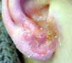 Allergische Reaktion auf Ohrring