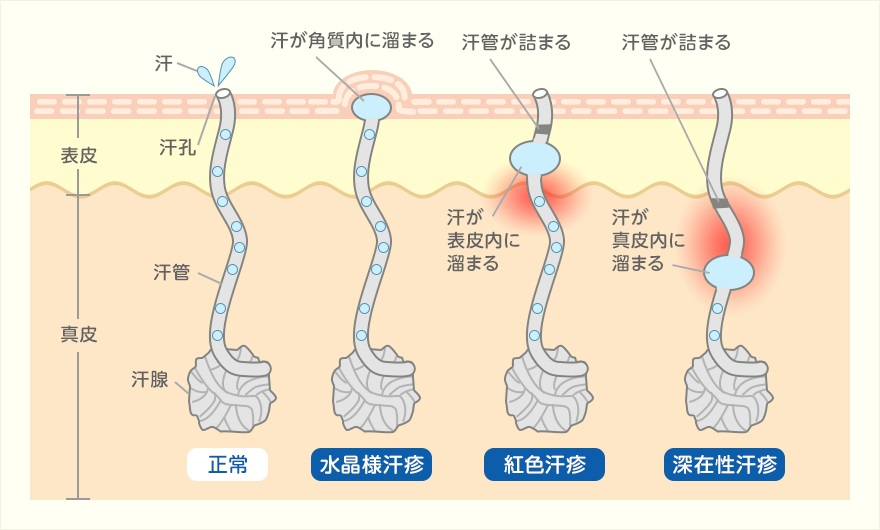 あせもの原因