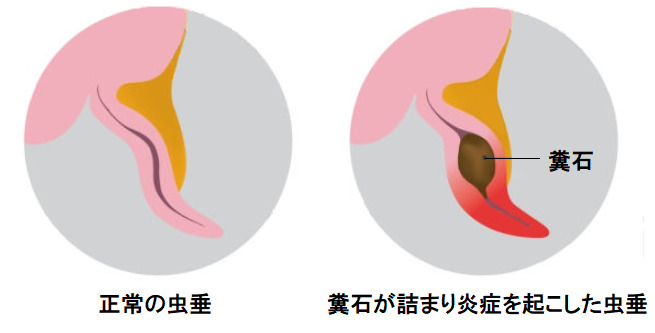 急性虫垂炎 茨木市の小児科 はら小児科クリニック