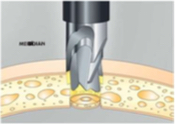 Internal Dura-mater Brake-secure