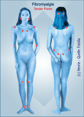 Ist Fibromyalgie heilbar oder nicht?