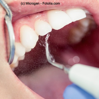 Regelmäßige Zahnsteinentfernung beim Zahnarzt ist wichtig