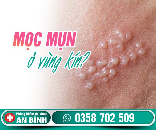 Vùng kín mọc mụn vì những nguyên nhân không ngờ tới.