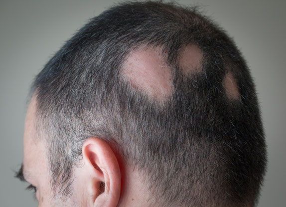 Scalp Pigmentatie (SMP): Meer dan een Optische Illusie – Een Krachtig Nieuw Begin