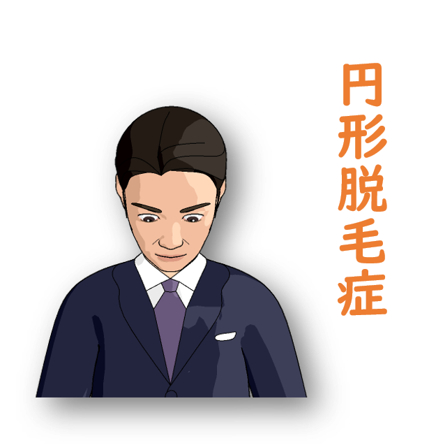円形脱毛症の図