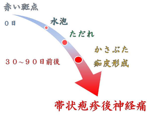 疱疹 なる 楽に 帯状 で 神経痛 の 後 これ は