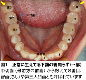 親知らずは抜歯する歯なのか 梅本歯科医院