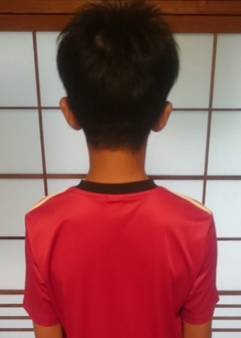 オスグッド改善した子供