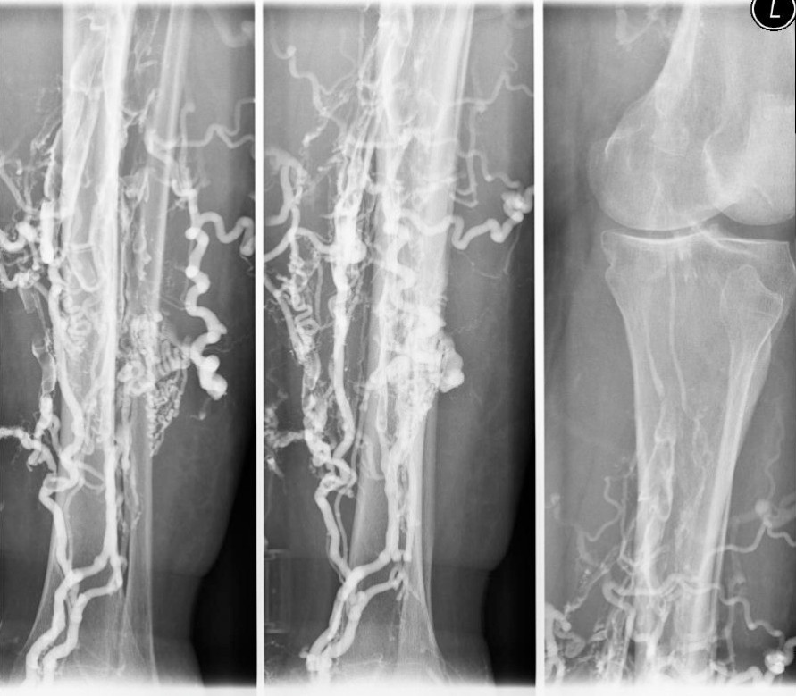 Venen / Phlebographie - Radiologie Herford Wiesestrasse – Nuklearmedizin, Kernspintomographie ...