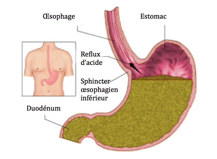 Acidité Gastrique : Trop ou Trop Peu Minéraux et Corps