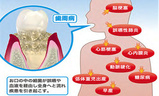 歯周病菌　全身の病気をひきおこす