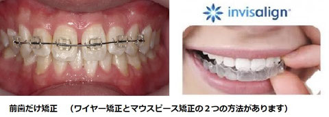 前歯矯正　インビザライン　マウスピース矯正