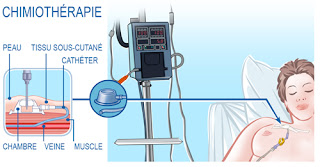 Chambre Implantable Dvi Pac Sauvez Mes Boobs Sinon Rien