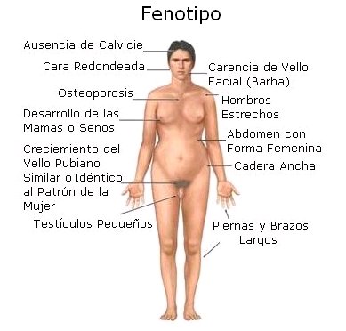 sindrome de klinefelter en mujer