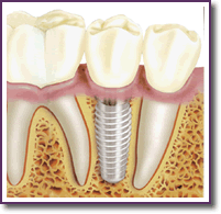 Diagrama Implante Dental