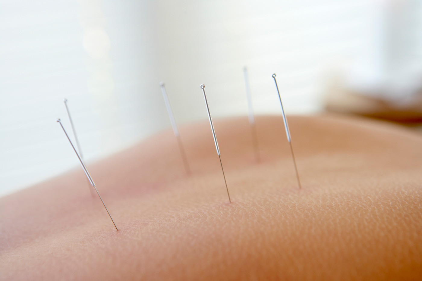 ACUPUNCTURE L #39 inspiration de la Nature