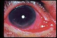úlcera corneal