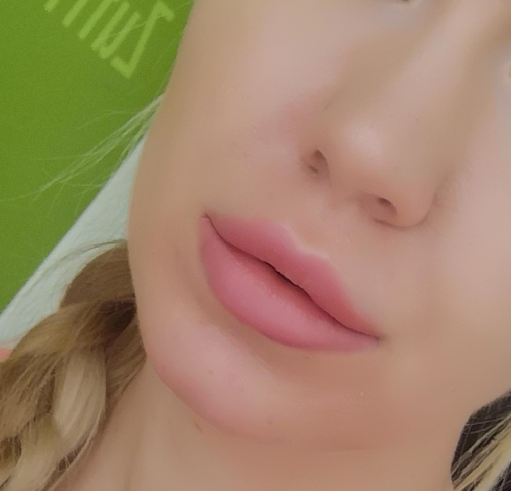 Lippenunterspritzung 
