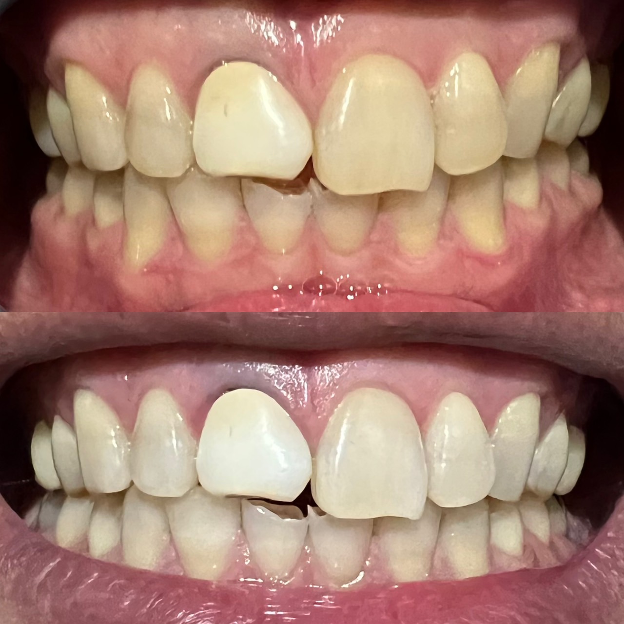 ホワイトニングbefore＆after