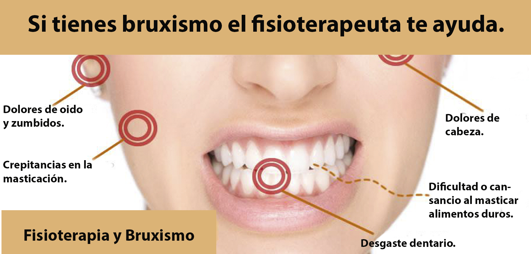 TRATAMIENTO DE CASOS DE ATM COMO BRUXISMO CON FISIOTERAPIA Y OSTEOPATÍA