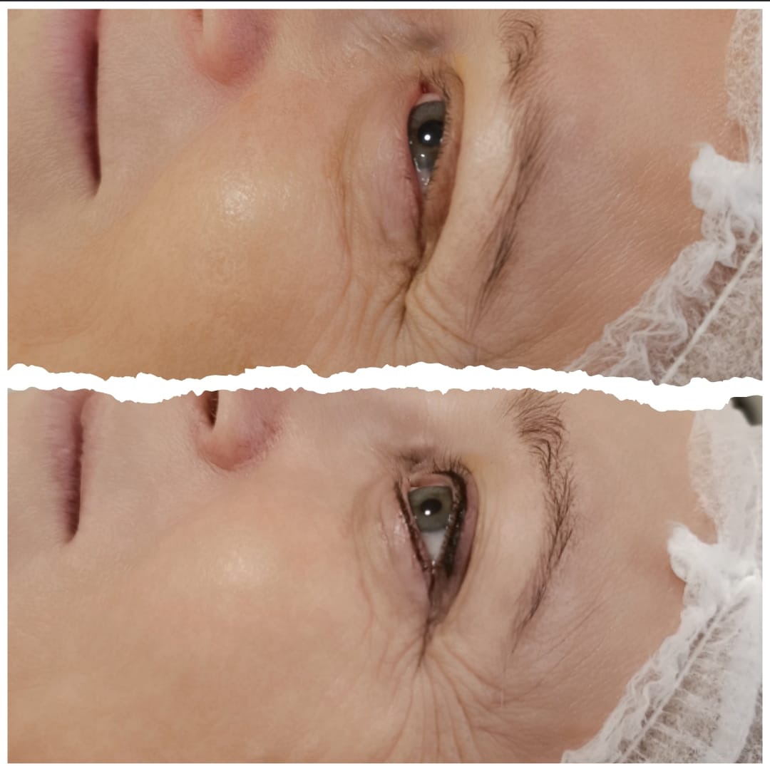 Wimpernkranzverdichtung oben & unten