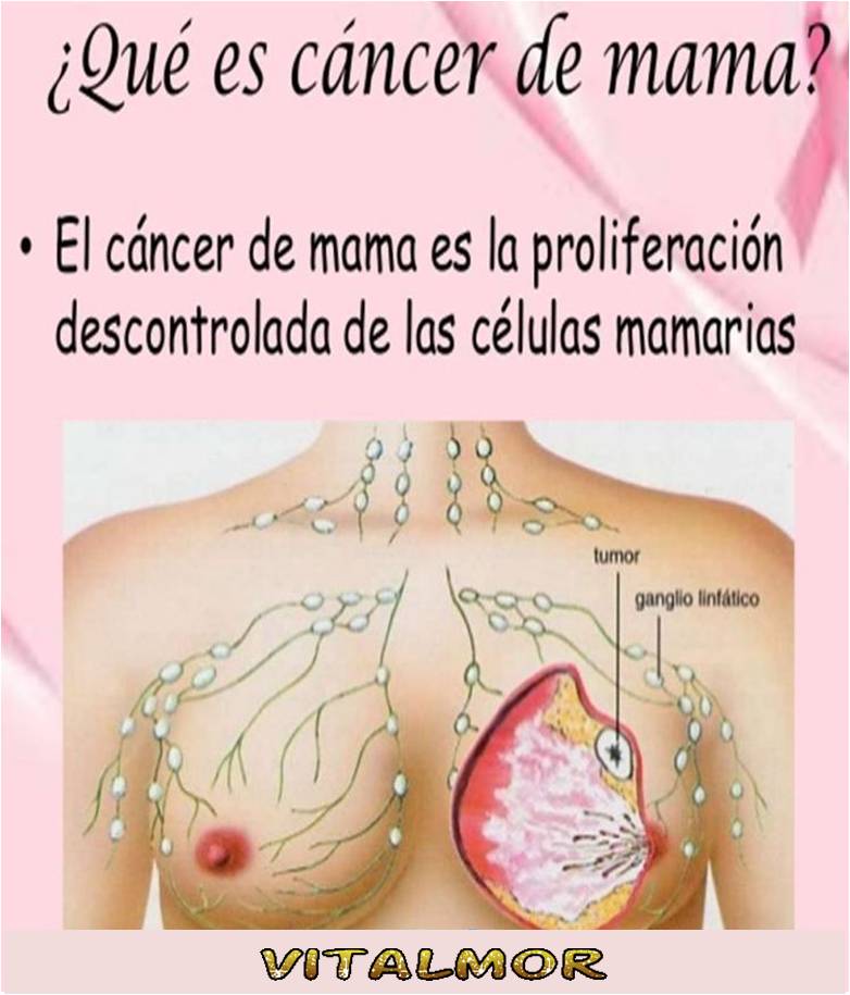 Cáncer de mama