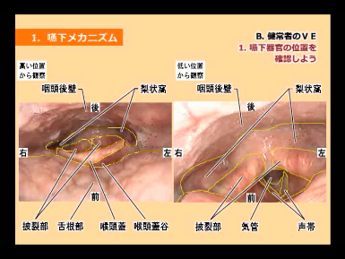 嚥下内視鏡検査（VE)の写真を使った嚥下器官の解剖図