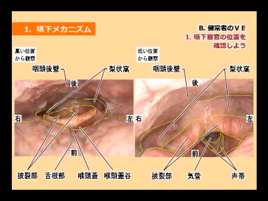 頸部聴診法習得を目指す方への基礎講座 - 嚥下リハサポート