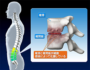 腰痛を引き起こす病気の種類とは 痛みのない整体で根本的改善 いつまでも動ける身体を