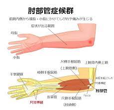 肘部管症候群について