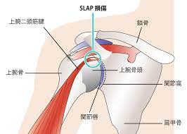 SLAP損傷について