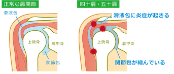 四十肩・五十肩